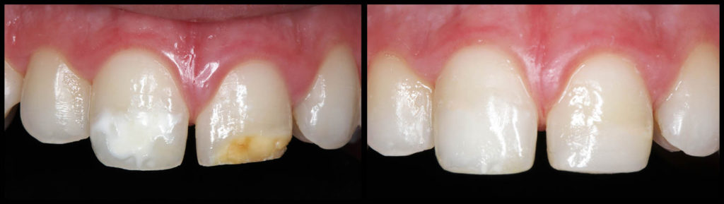 Fillings - DAY AND NIGHT DENTAL