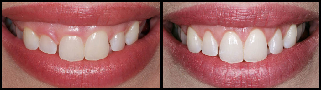Gummy Smile & Gum Contouring Recovery - How Long? Will it Hurt?