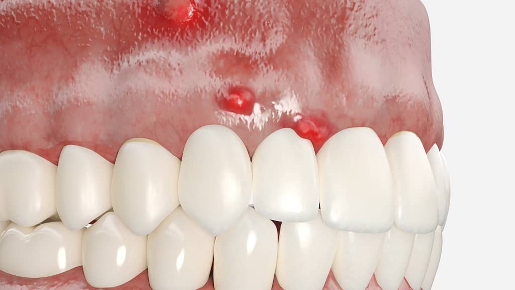 abscess tooth drain